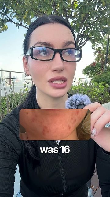 Creator 2 with acne photo overlay